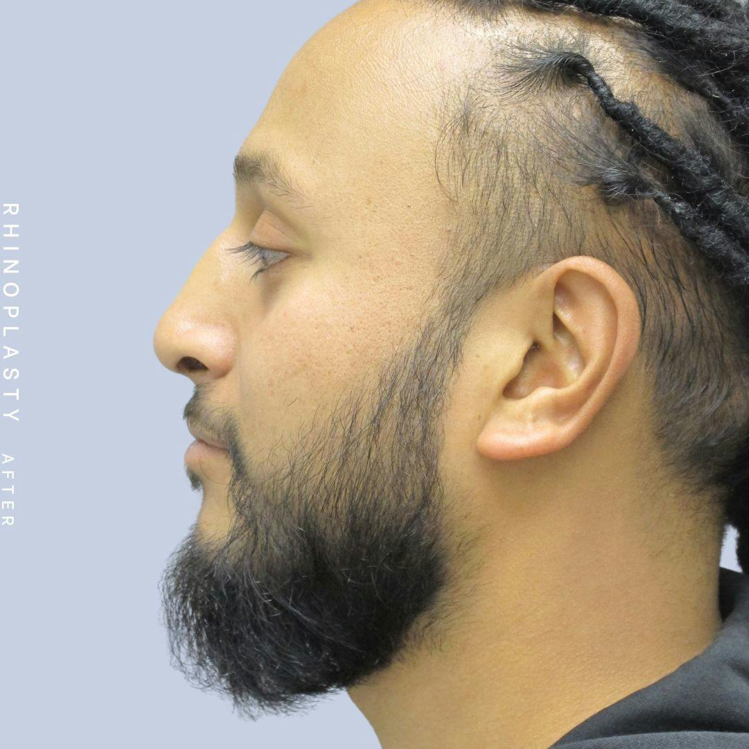 Nose Before & After Gallery - Patient 120868334 - Image 6