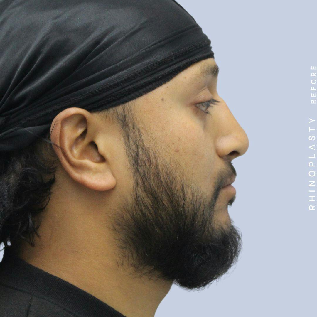 Nose Before & After Gallery - Patient 120868334 - Image 7