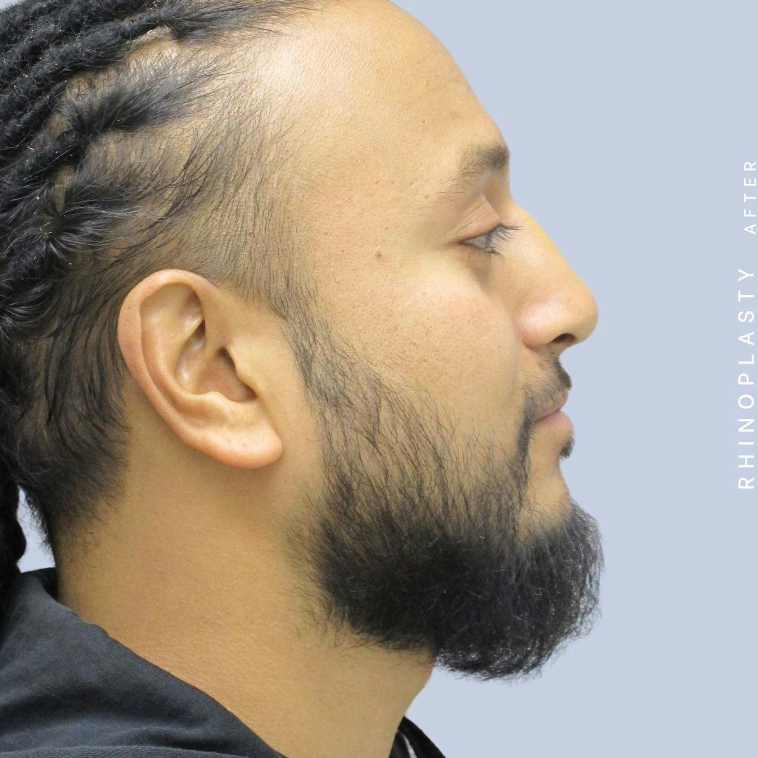 Nose Before & After Gallery - Patient 120868334 - Image 8