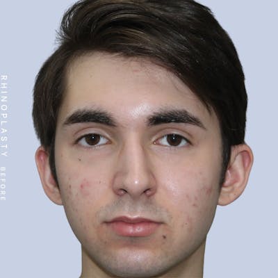 Men's Nose Before & After Gallery - Patient 120868387 - Image 1