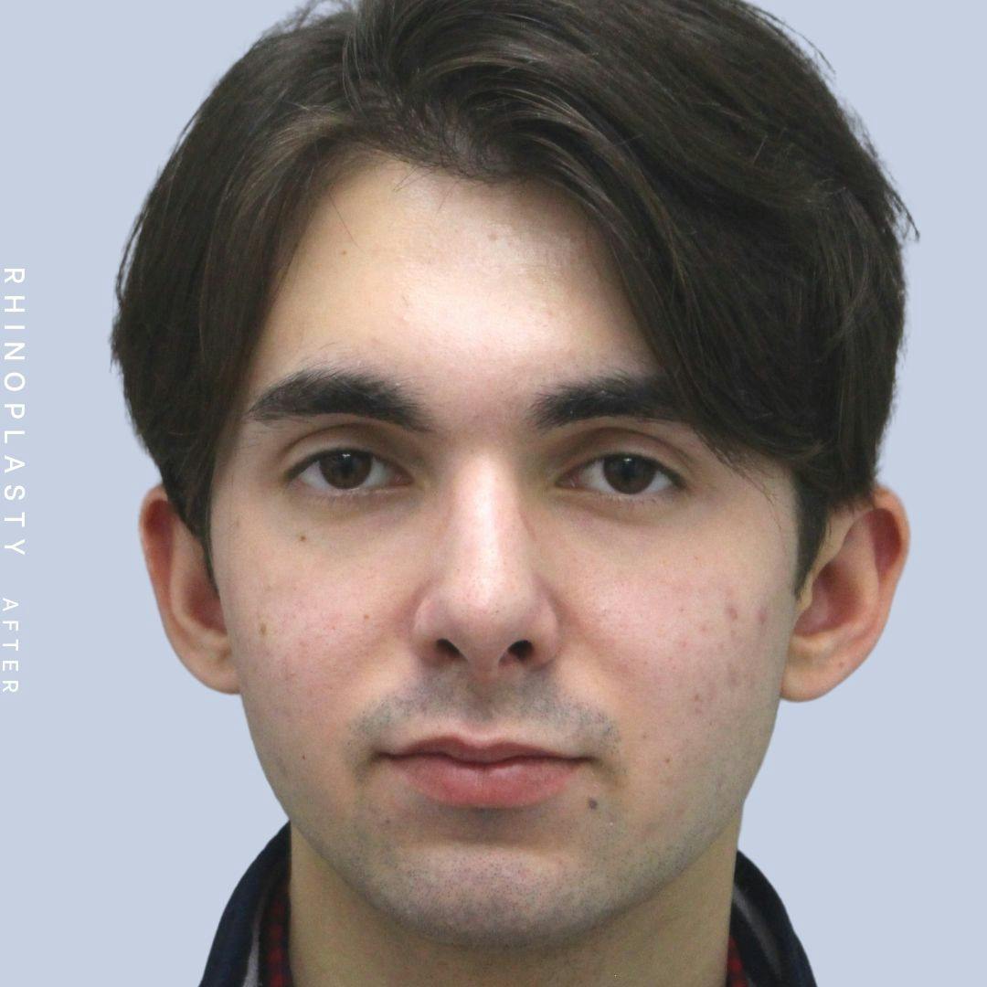 Nose Before & After Gallery - Patient 120868386 - Image 2