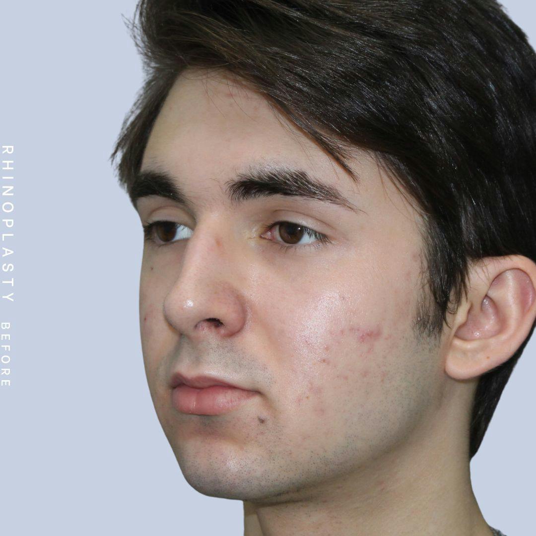 Nose Before & After Gallery - Patient 120868386 - Image 3