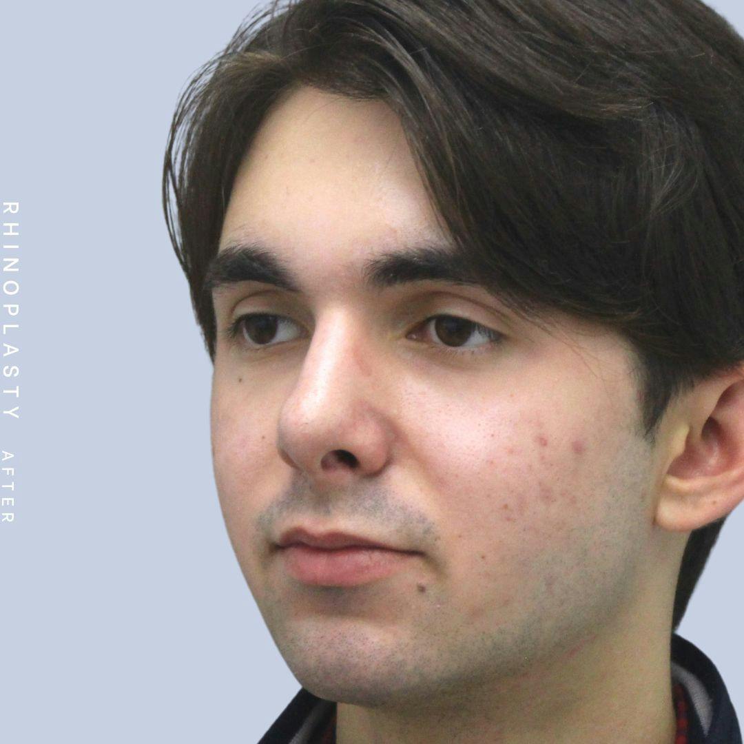 Nose Before & After Gallery - Patient 120868386 - Image 4