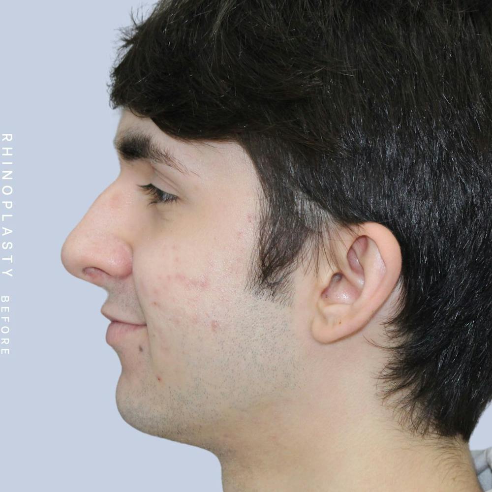 Nose Before & After Gallery - Patient 120868387 - Image 5