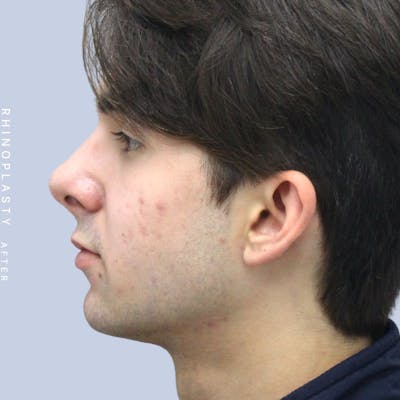 Men's Nose Before & After Gallery - Patient 120868387 - Image 6