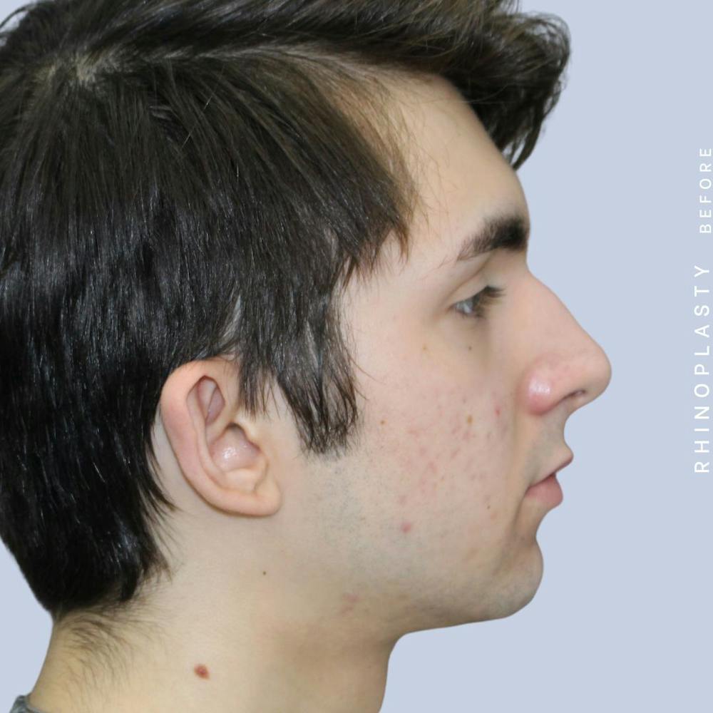 Nose Before & After Gallery - Patient 120868387 - Image 7