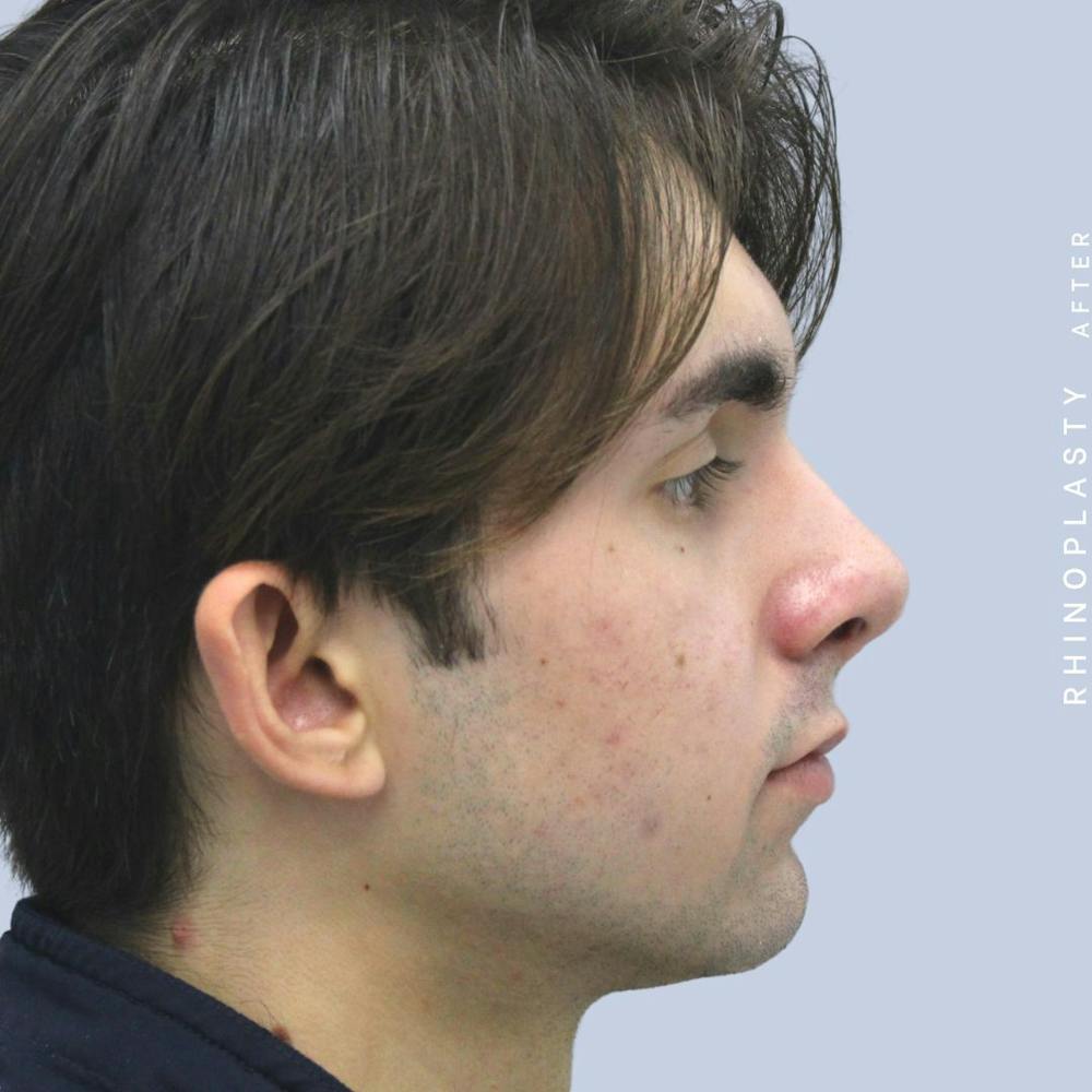 Nose Before & After Gallery - Patient 120868386 - Image 8