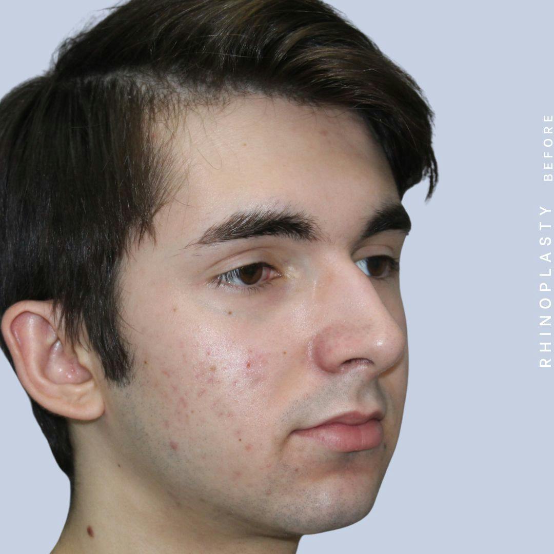 Nose Before & After Gallery - Patient 120868386 - Image 9