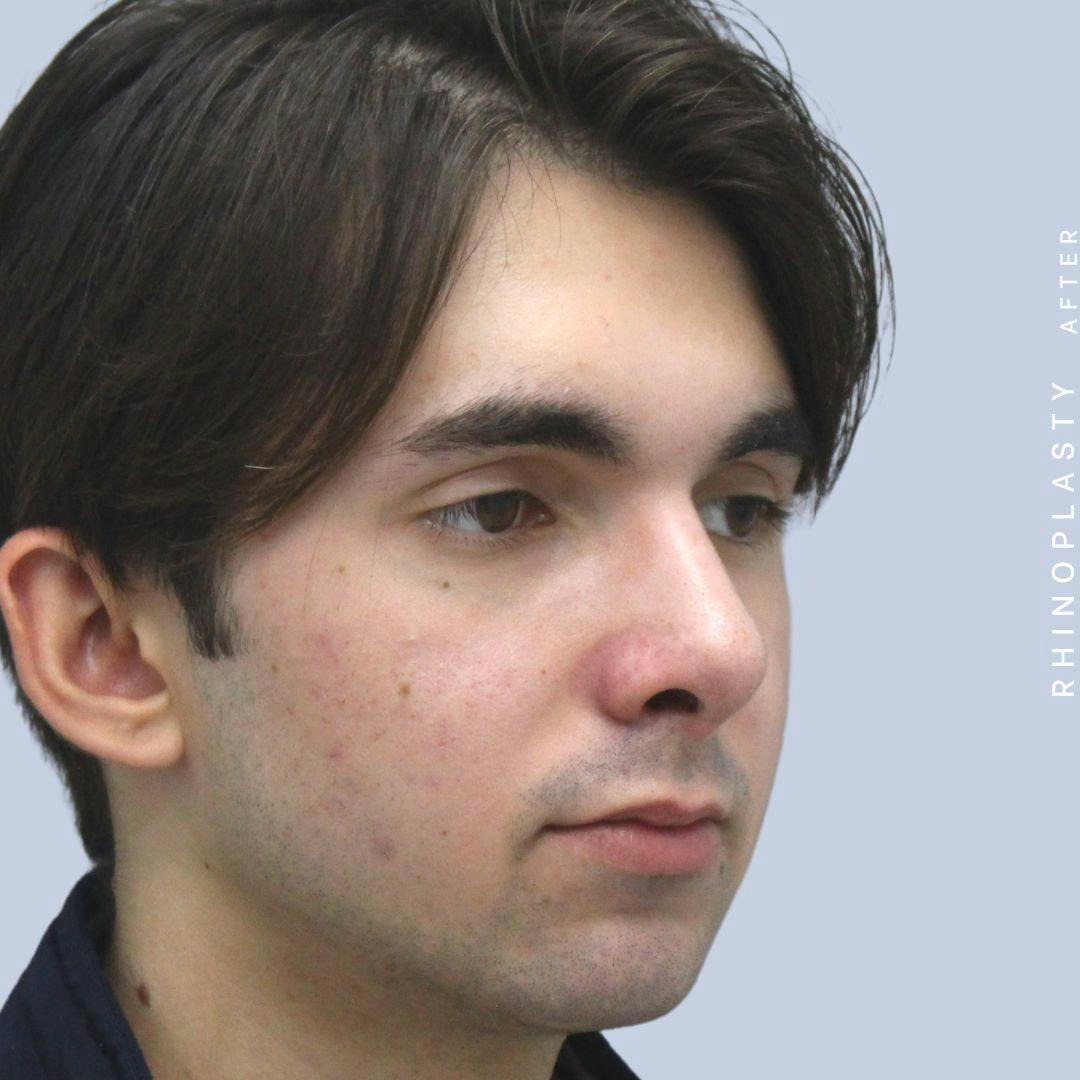 Nose Before & After Gallery - Patient 120868386 - Image 10