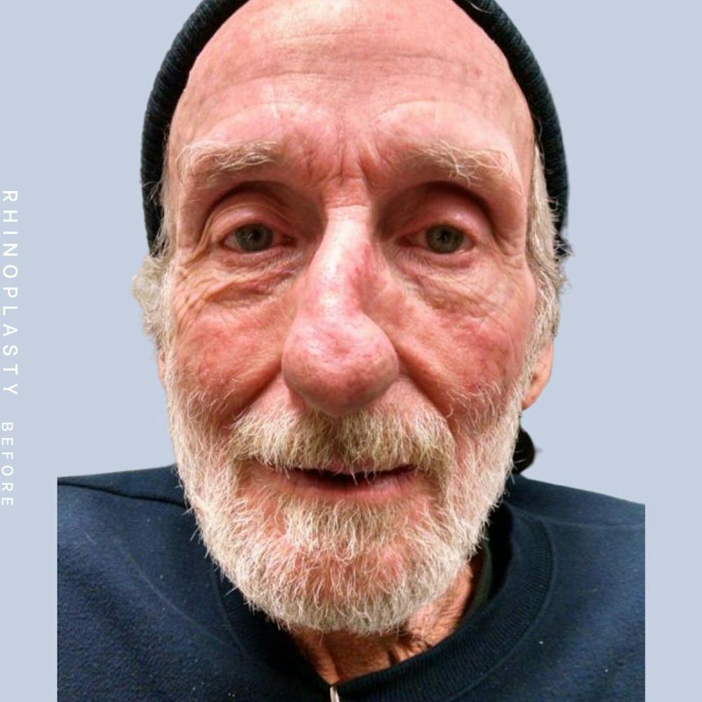 Men's Nose Before & After Gallery - Patient 121123753 - Image 1
