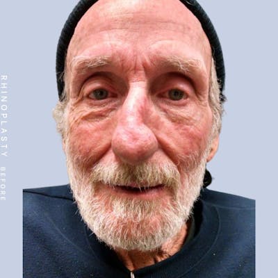 Men's Nose Before & After Gallery - Patient 121123753 - Image 1