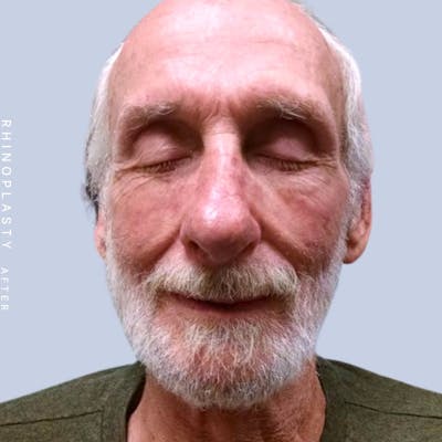Nose Before & After Gallery - Patient 121123750 - Image 2