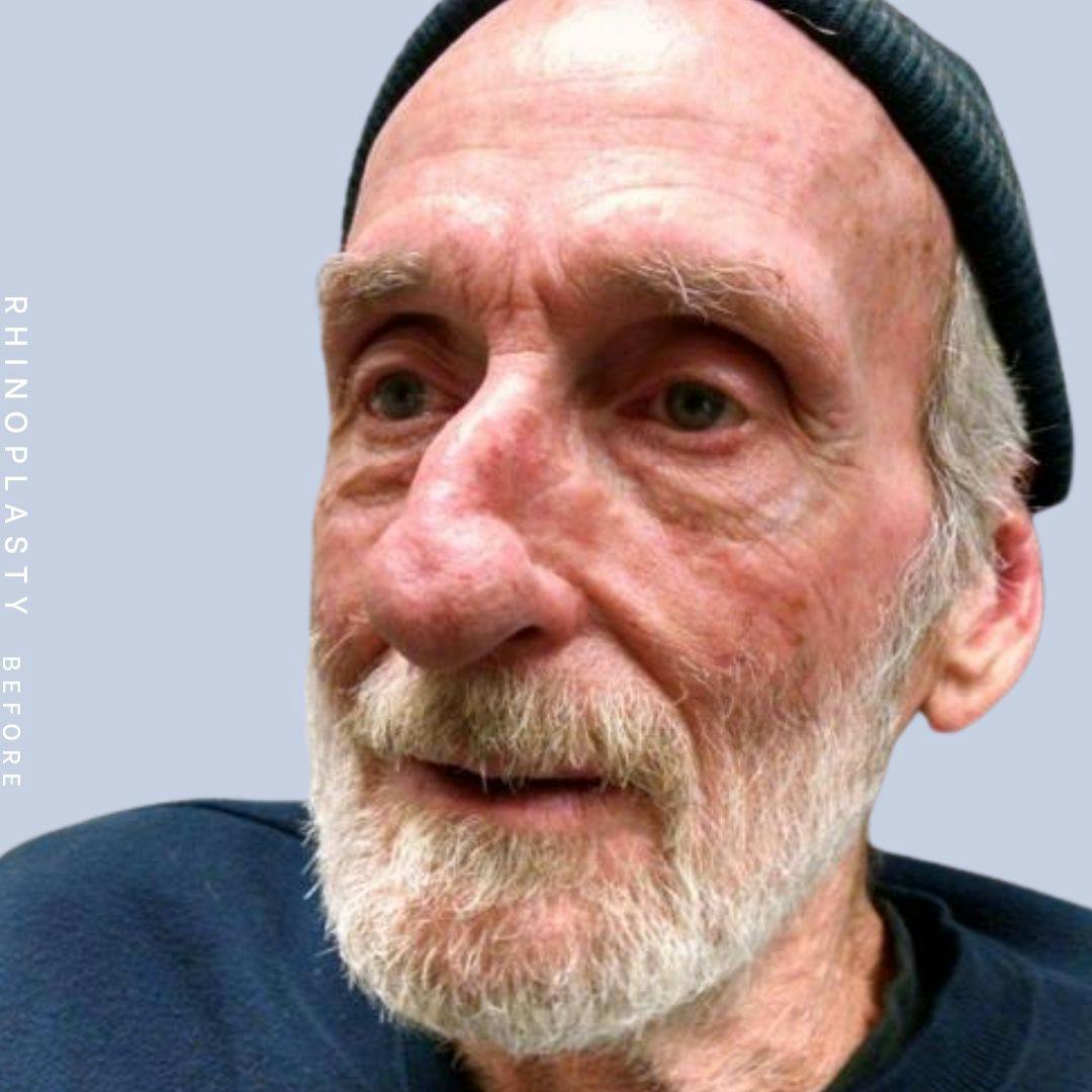 Nose Before & After Gallery - Patient 121123750 - Image 3