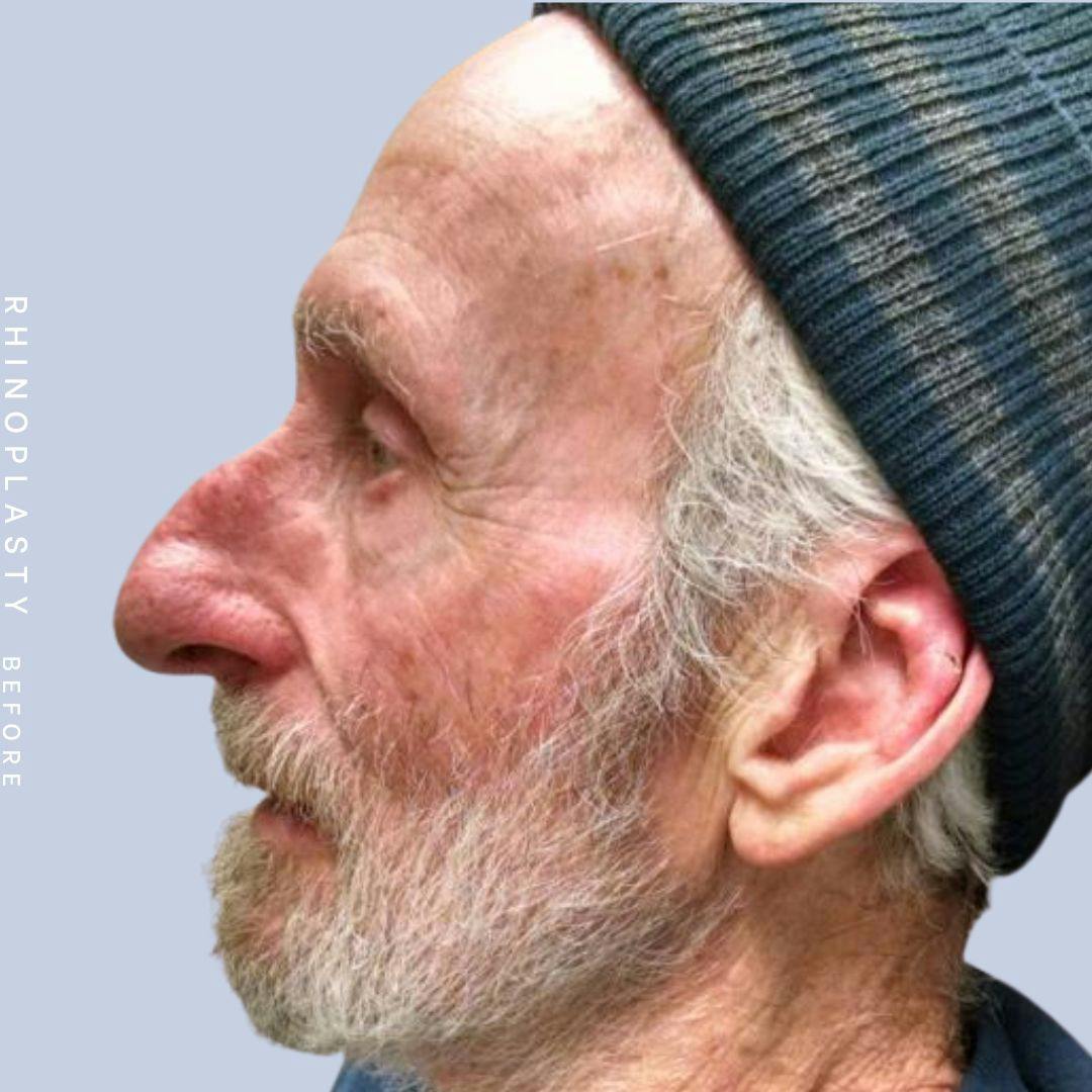 Nose Before & After Gallery - Patient 121123750 - Image 5