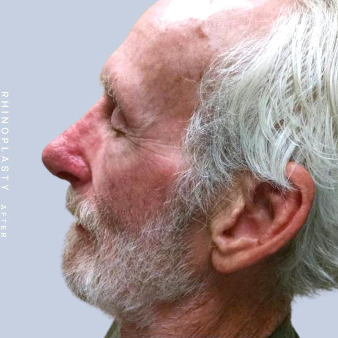 Nose Before & After Gallery - Patient 121123750 - Image 6