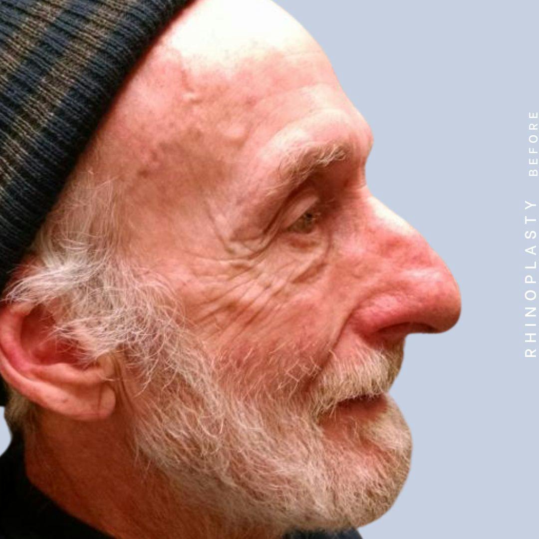 Nose Before & After Gallery - Patient 121123750 - Image 7