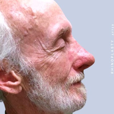 Men's Nose Before & After Gallery - Patient 121123753 - Image 8