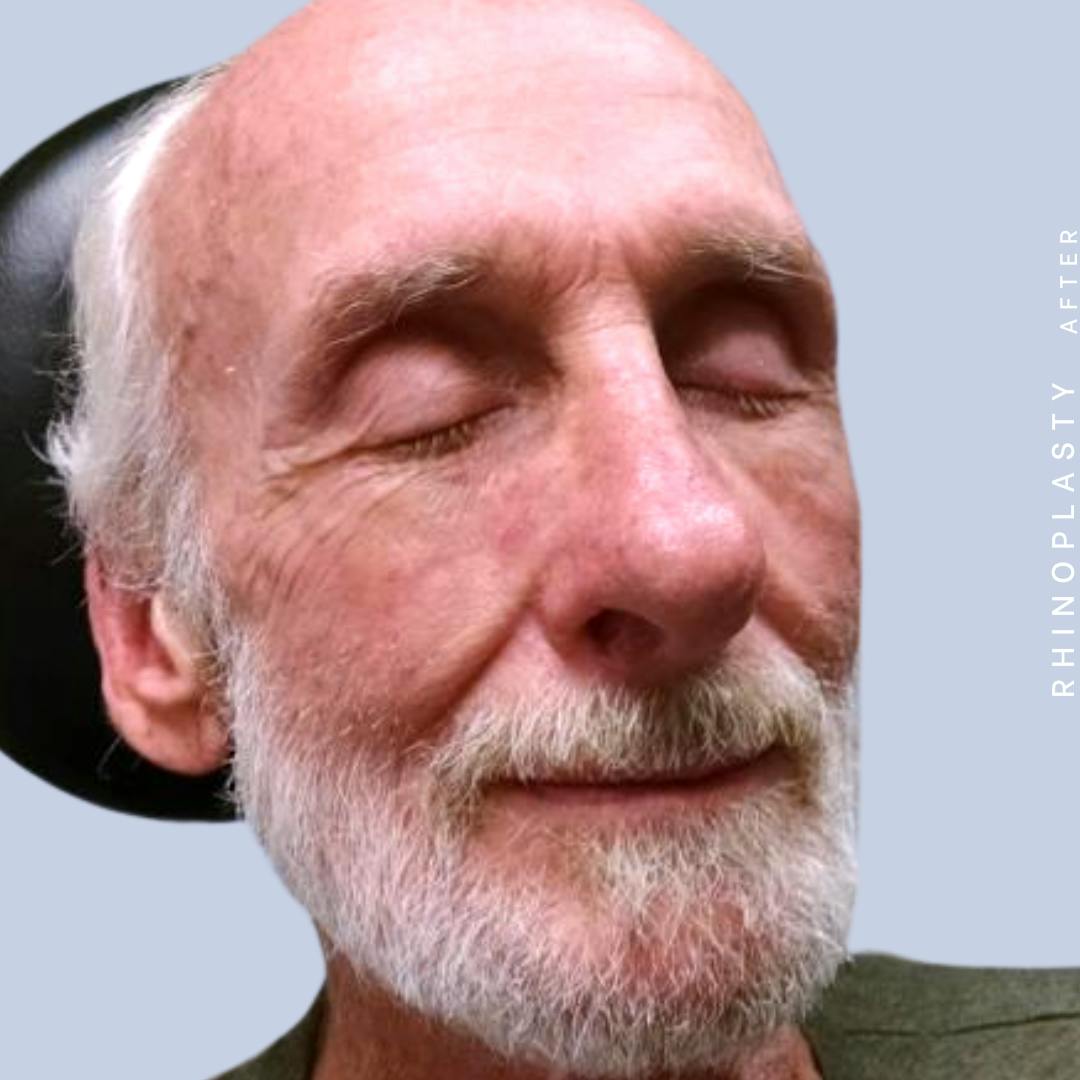 Nose Before & After Gallery - Patient 121123750 - Image 10