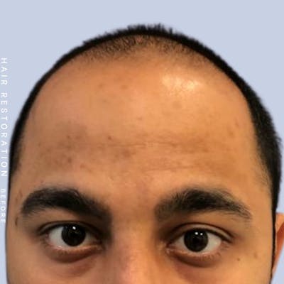 Men's Hair Before & After Gallery - Patient 122053796 - Image 1