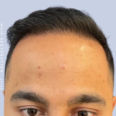 Hair Restoration Before & After Gallery - Patient 122053797 - Image 2