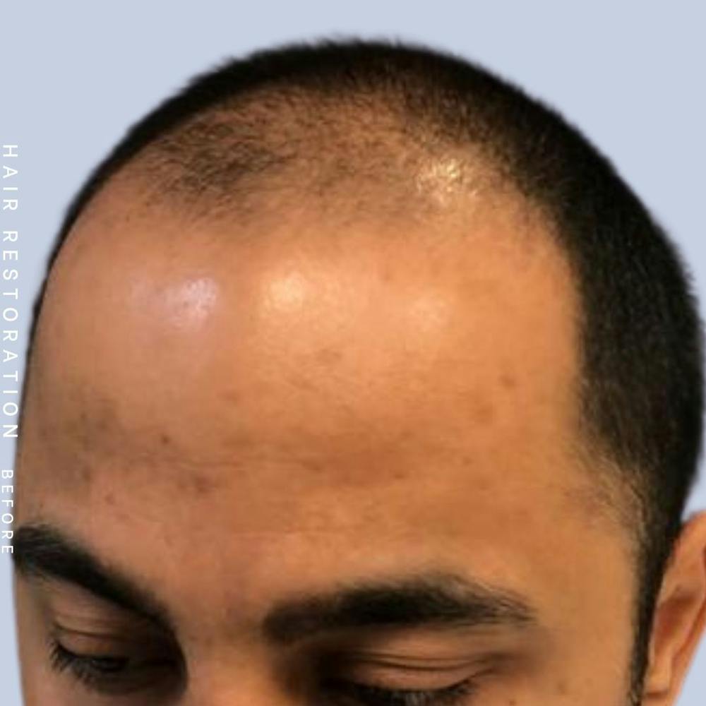Hair Restoration Before & After Gallery - Patient 122053797 - Image 3