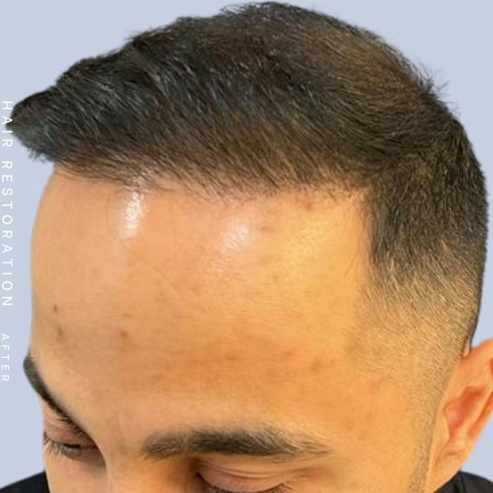 Hair Restoration Before & After Gallery - Patient 122053797 - Image 4