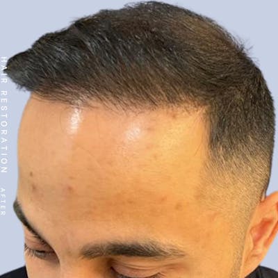 Hair Restoration Before & After Gallery - Patient 122053797 - Image 4