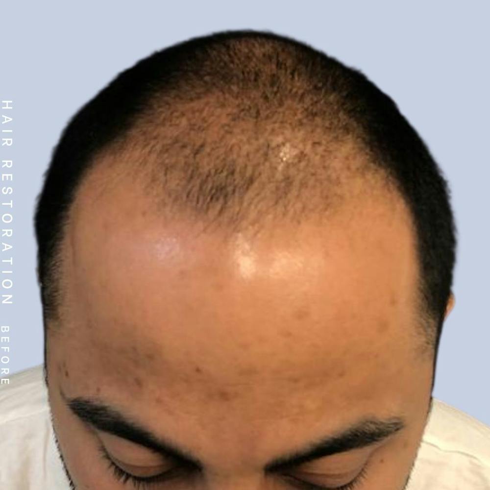 Hair Restoration Before & After Gallery - Patient 122053797 - Image 5