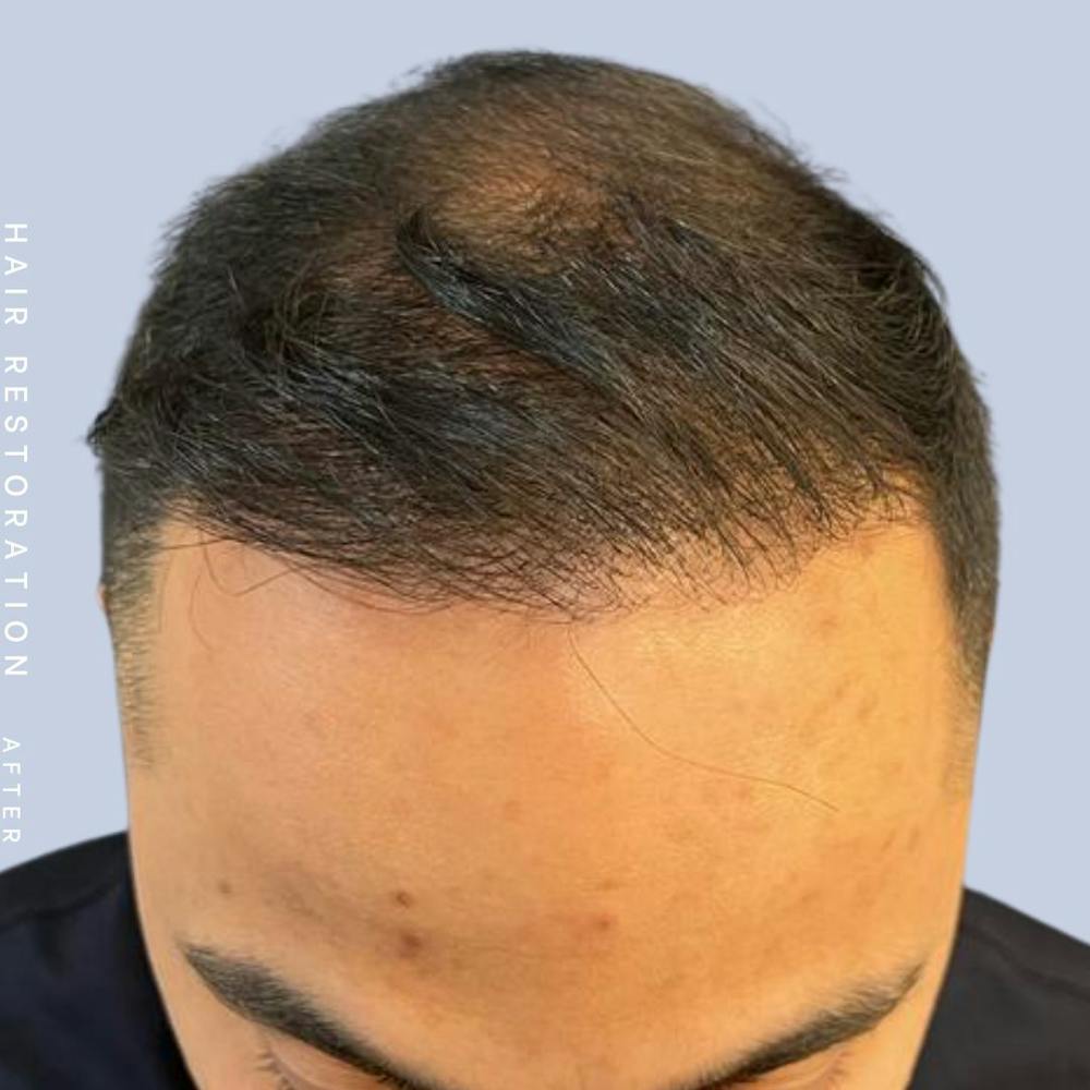Hair Restoration Before & After Gallery - Patient 122053797 - Image 6