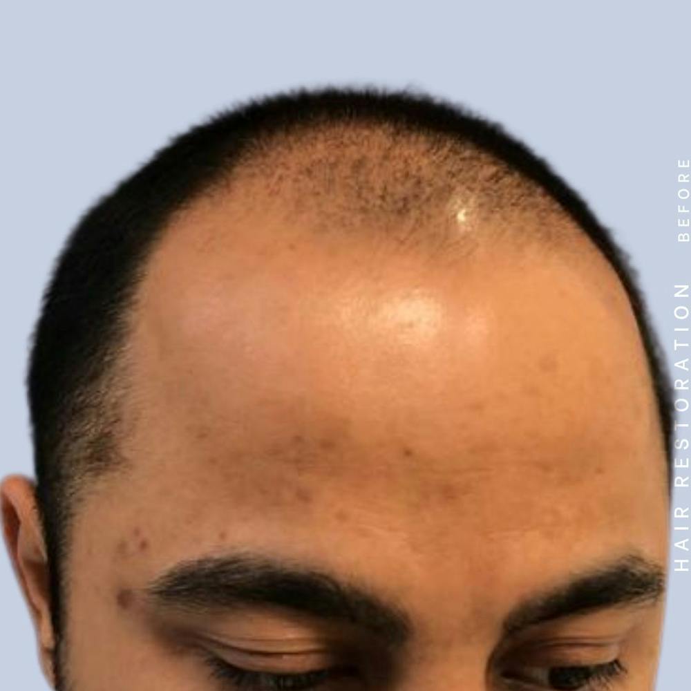 Men's Hair Before & After Gallery - Patient 122053796 - Image 7