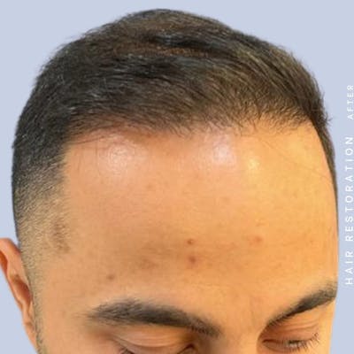 Men's Hair Before & After Gallery - Patient 122053796 - Image 8
