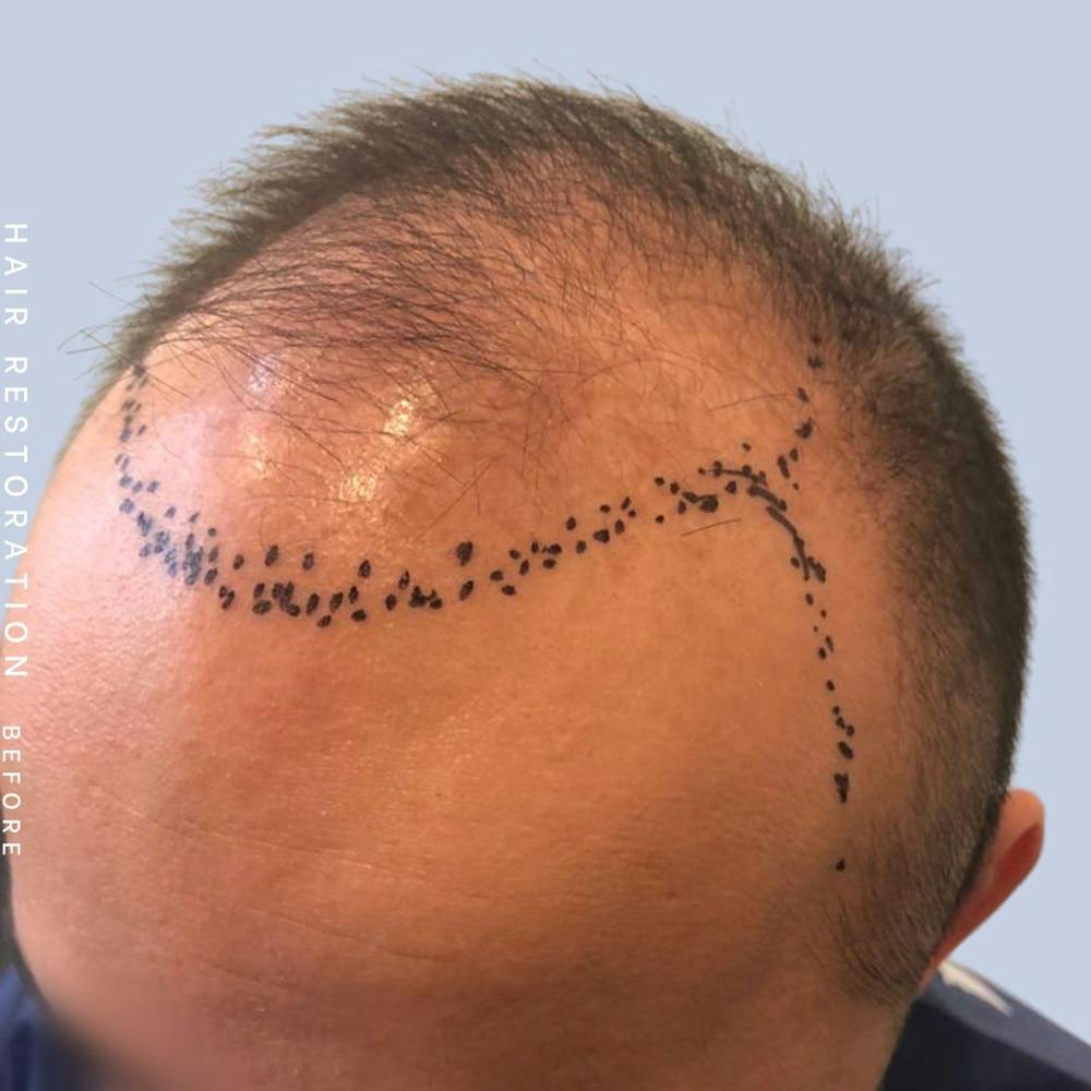 Hair Restoration Before & After Gallery - Patient 122053785 - Image 1