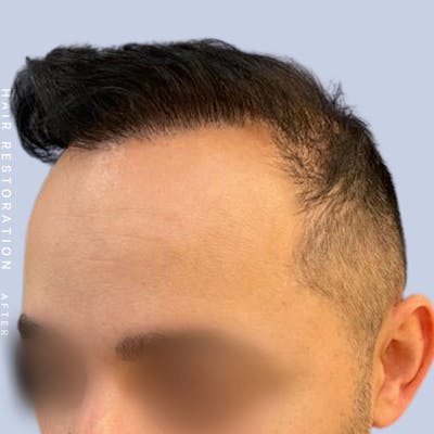 Hair Restoration Before & After Gallery - Patient 122053785 - Image 2