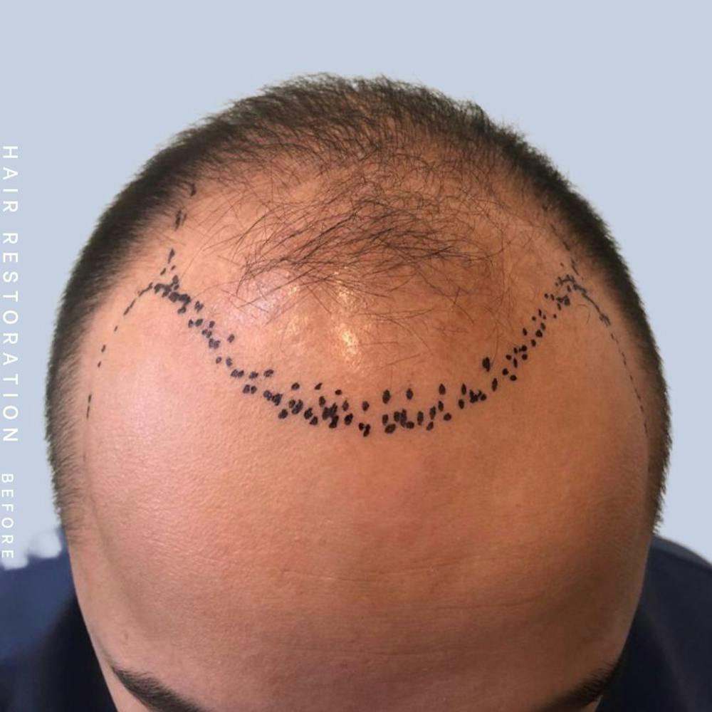 Hair Restoration Before & After Gallery - Patient 122053785 - Image 3