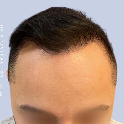 Hair Restoration Before & After Gallery - Patient 122053785 - Image 4