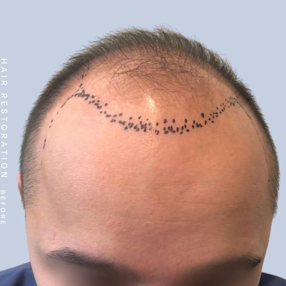 Hair Restoration Before & After Gallery - Patient 122053785 - Image 5
