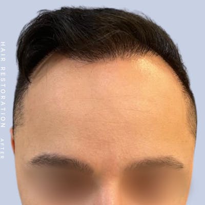Men's Hair Before & After Gallery - Patient 122053787 - Image 6