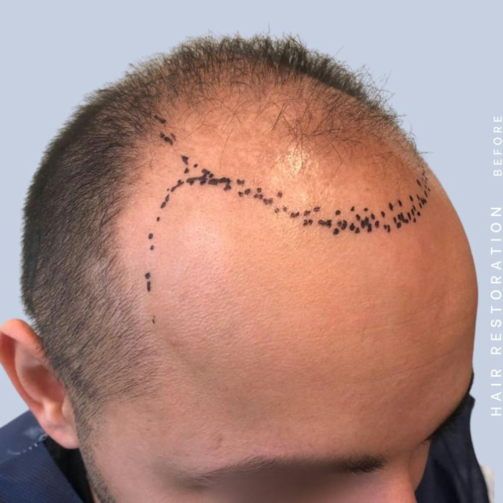 Hair Restoration Before & After Gallery - Patient 122053785 - Image 7