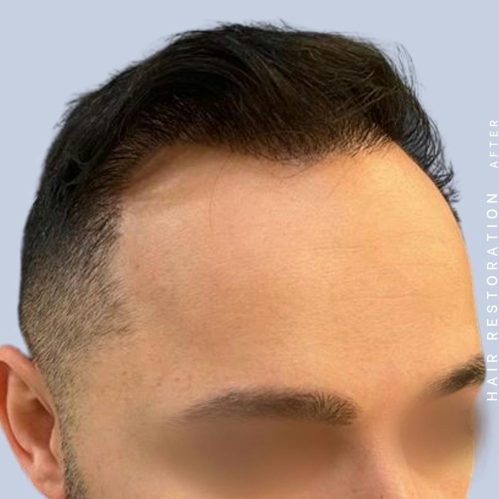 Men's Hair Before & After Gallery - Patient 122053787 - Image 8