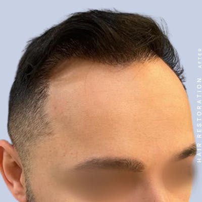 Hair Restoration Before & After Gallery - Patient 122053785 - Image 8
