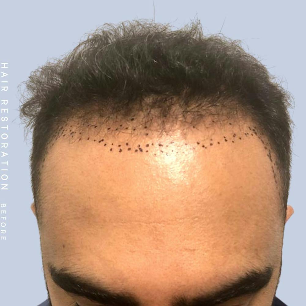 Hair Restoration Before & After Gallery - Patient 121417577 - Image 1