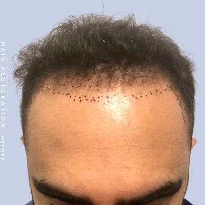 Men's Hair Before & After Gallery - Patient 121417579 - Image 1