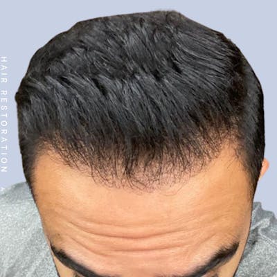 Men's Hair Before & After Gallery - Patient 121417579 - Image 2