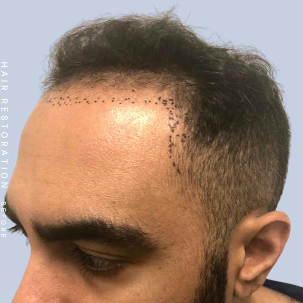 Hair Restoration Before & After Gallery - Patient 121417577 - Image 3