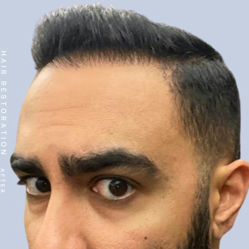 Hair Before & After Gallery - Patient 121417579 - Image 4