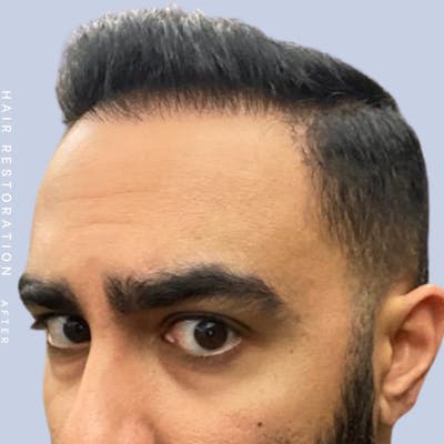 Hair Before & After Gallery - Patient 121417579 - Image 4