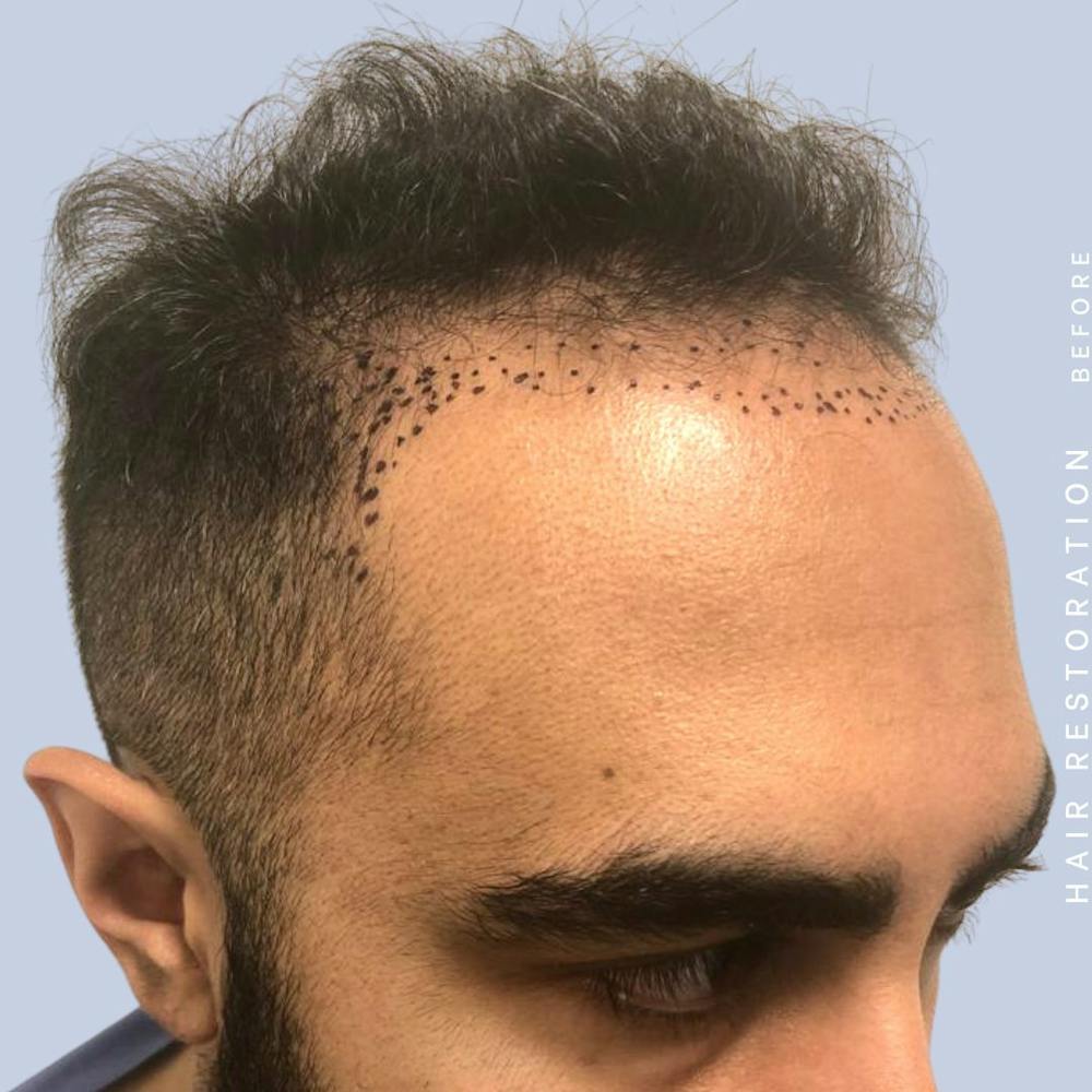 Hair Before & After Gallery - Patient 121417579 - Image 5