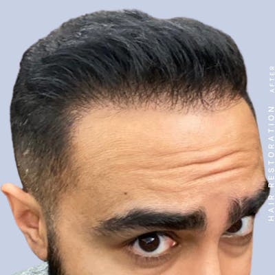 Hair Before & After Gallery - Patient 121417579 - Image 6