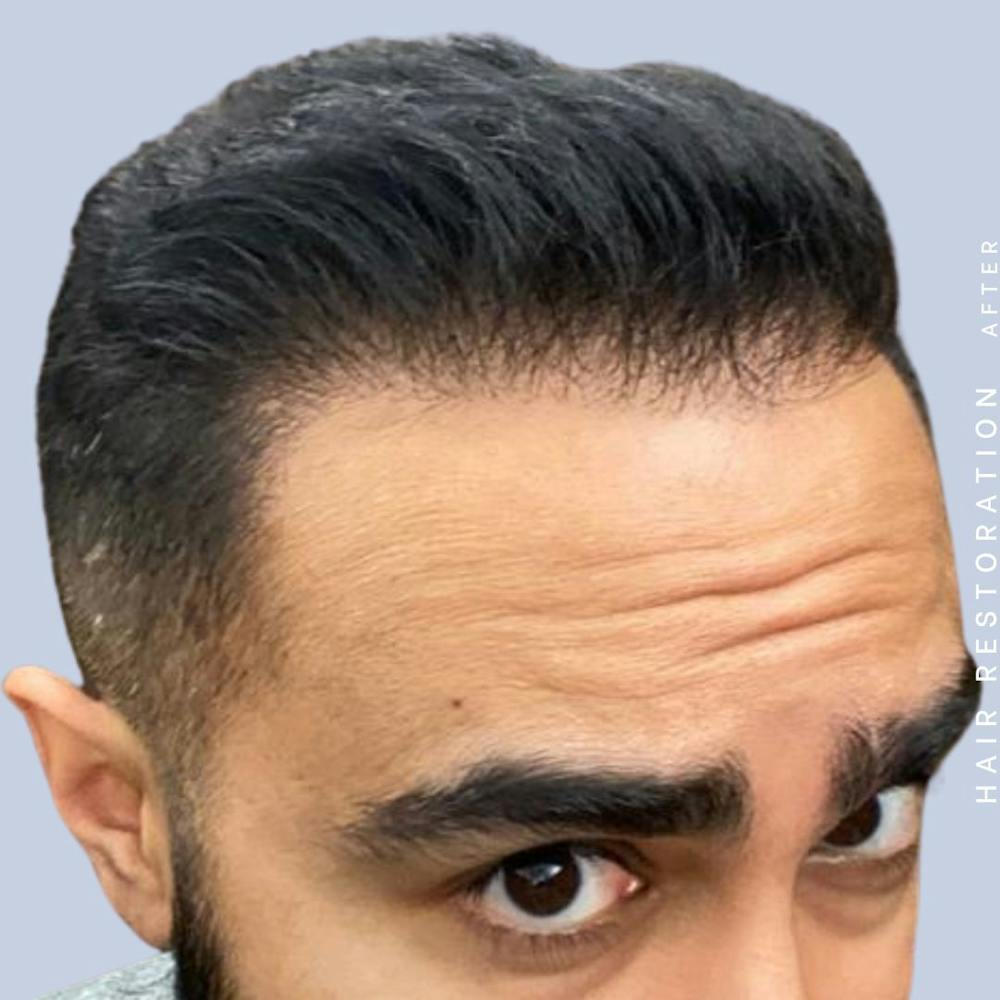 Hair Restoration Before & After Gallery - Patient 121417577 - Image 6