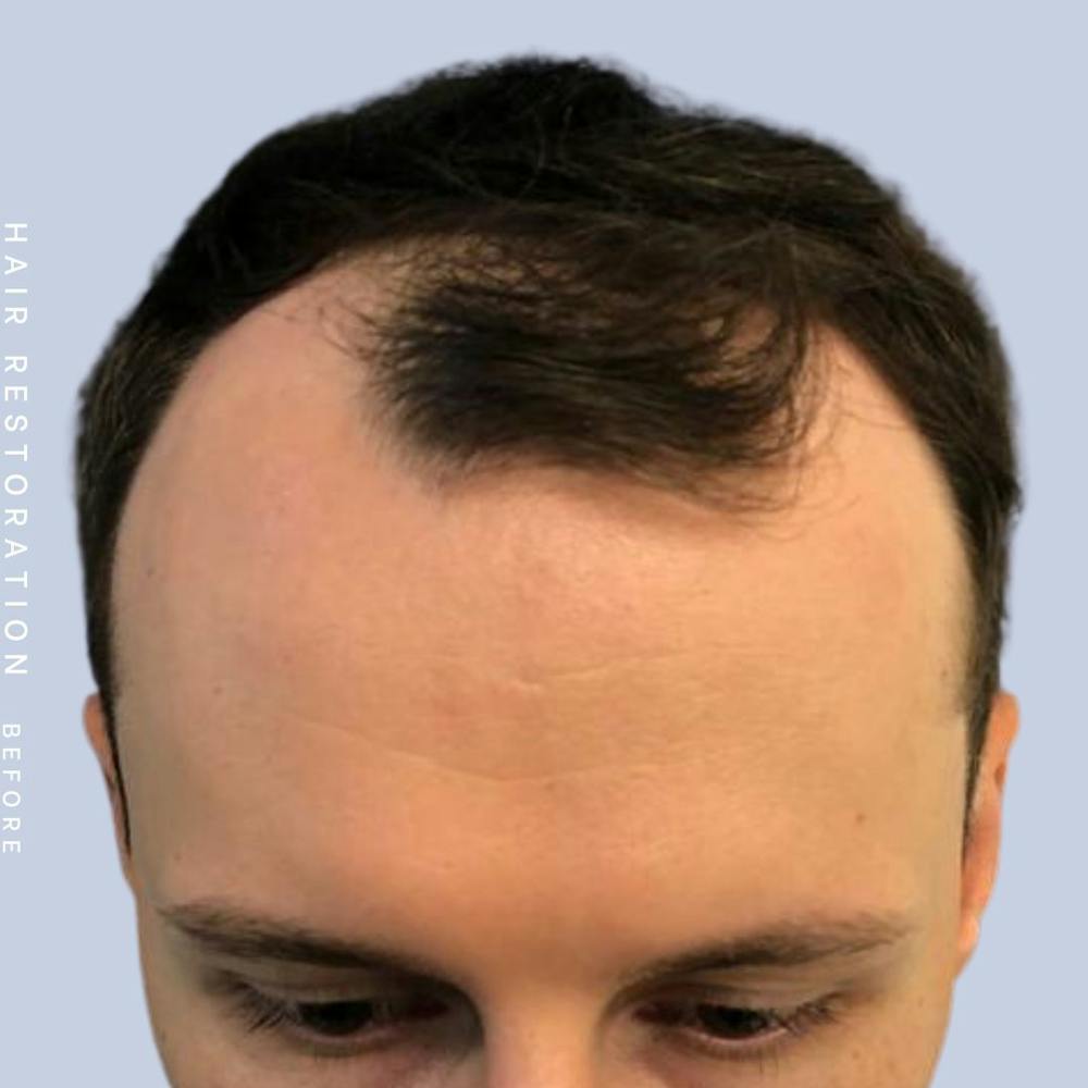 Hair Restoration Before & After Gallery - Patient 121417574 - Image 1